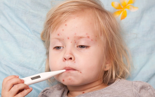 Qızılcaya yoluxmada kəskin artım var