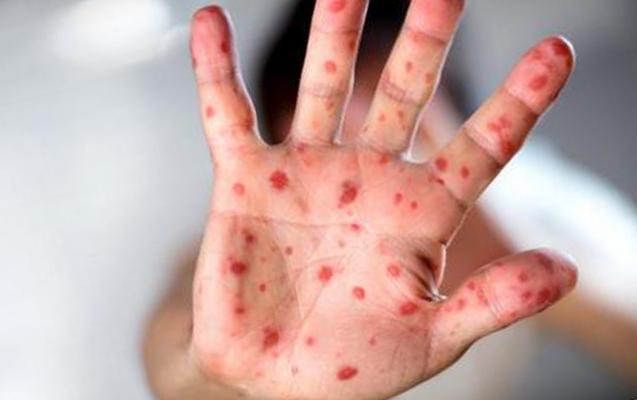 Ölkədə qızılca və suçiçəyi ilə bağlı vəziyyət necədir? - Rəsmi